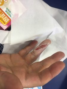 やけど傷
